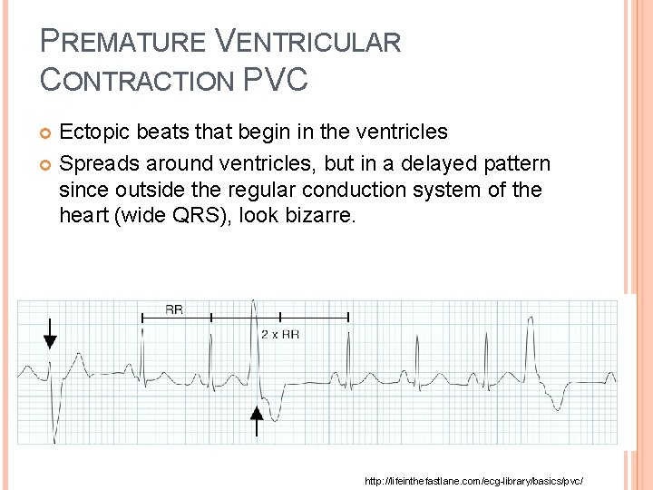 PREMATURE VENTRICULAR CONTRACTION PVC Ectopic beats that begin in the ventricles Spreads around ventricles,