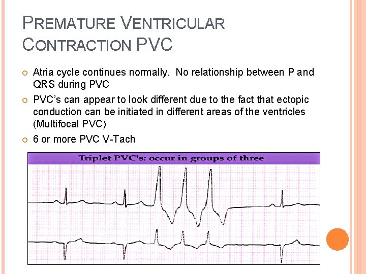 PREMATURE VENTRICULAR CONTRACTION PVC Atria cycle continues normally. No relationship between P and QRS