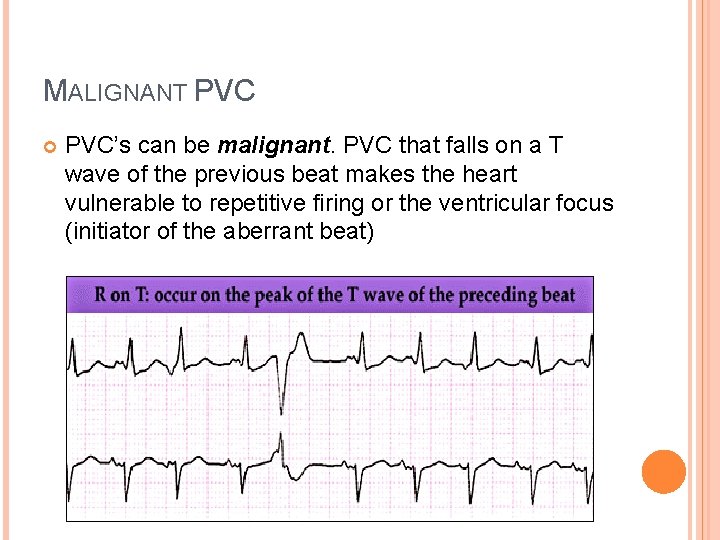 MALIGNANT PVC’s can be malignant. PVC that falls on a T wave of the