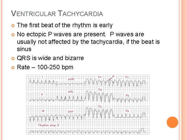 VENTRICULAR TACHYCARDIA The first beat of the rhythm is early No ectopic P waves