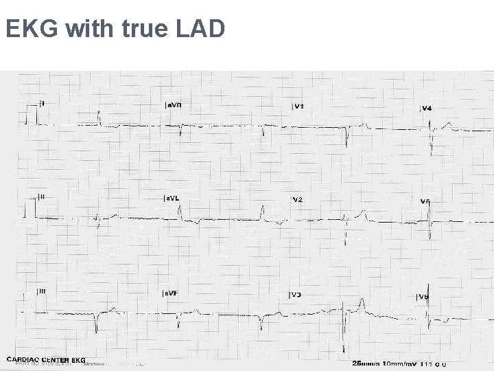 EKG with true LAD 