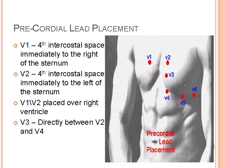 PRE-CORDIAL LEAD PLACEMENT V 1 – 4 th intercostal space immediately to the right