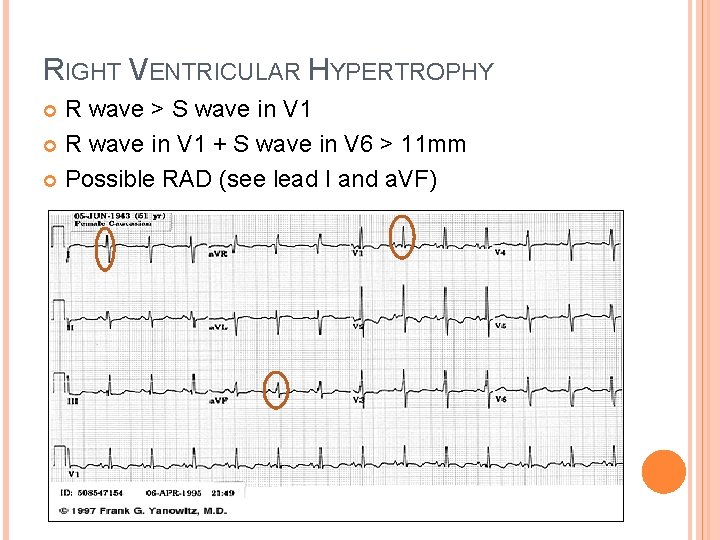 RIGHT VENTRICULAR HYPERTROPHY R wave > S wave in V 1 R wave in