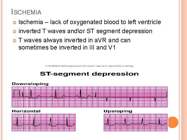 ISCHEMIA Ischemia – lack of oxygenated blood to left ventricle inverted T waves andor