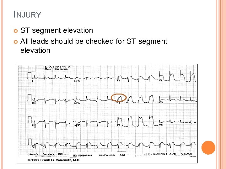 INJURY ST segment elevation All leads should be checked for ST segment elevation 