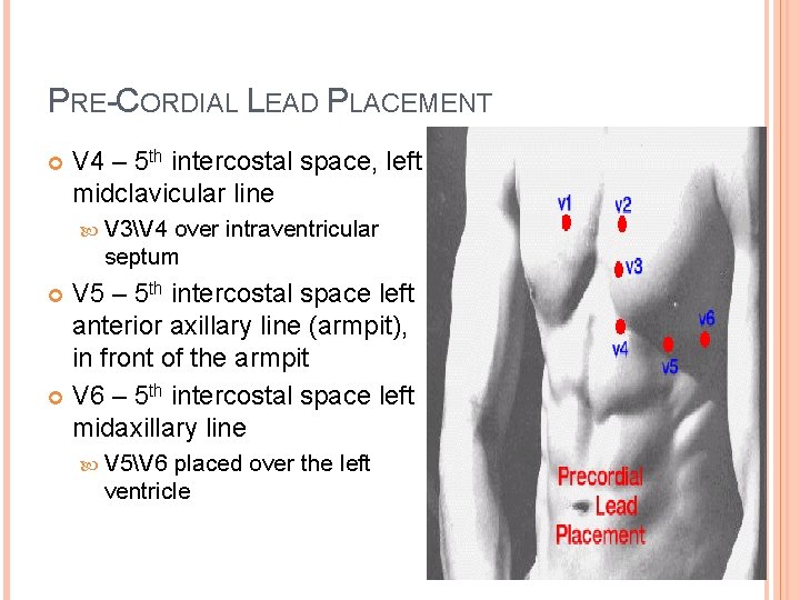 PRE-CORDIAL LEAD PLACEMENT V 4 – 5 th intercostal space, left midclavicular line V