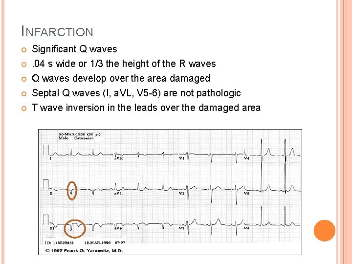 INFARCTION Significant Q waves. 04 s wide or 1/3 the height of the R
