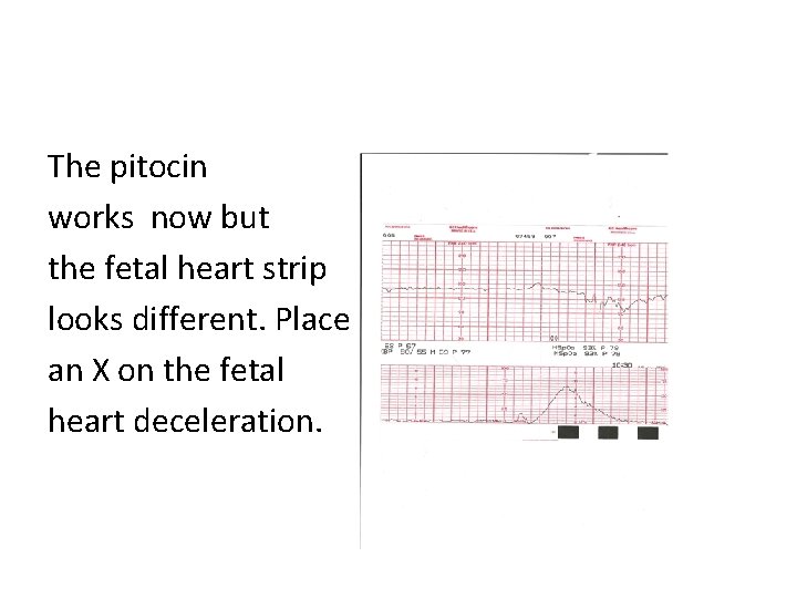 The pitocin works now but the fetal heart strip looks different. Place an X