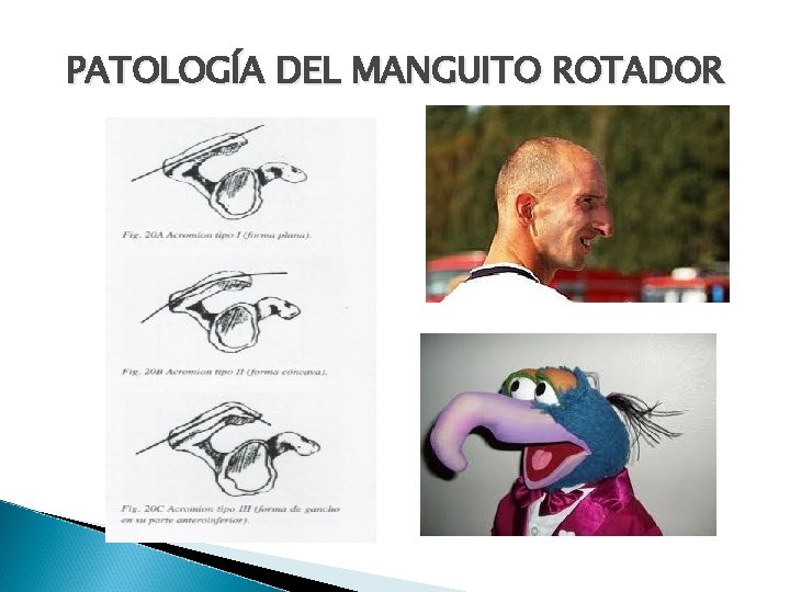 PATOLOGÍA DEL MANGUITO ROTADOR 