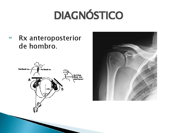 DIAGNÓSTICO Rx anteroposterior de hombro. 
