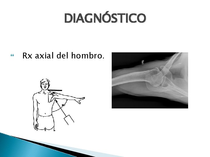 DIAGNÓSTICO Rx axial del hombro. 