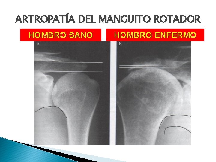 ARTROPATÍA DEL MANGUITO ROTADOR HOMBRO SANO HOMBRO ENFERMO 