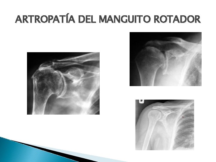 ARTROPATÍA DEL MANGUITO ROTADOR 