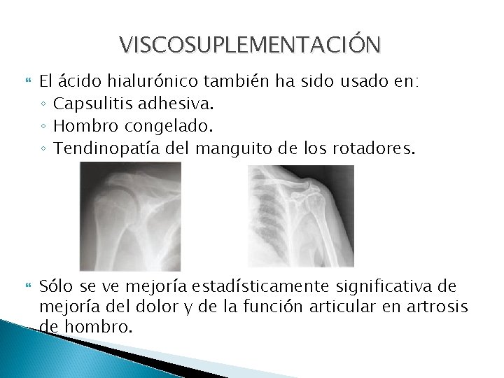 VISCOSUPLEMENTACIÓN El ácido hialurónico también ha sido usado en: ◦ Capsulitis adhesiva. ◦ Hombro