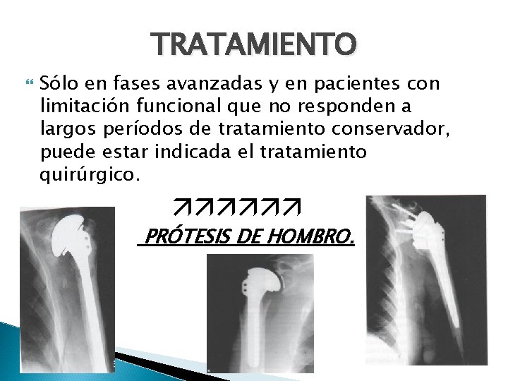 TRATAMIENTO Sólo en fases avanzadas y en pacientes con limitación funcional que no responden