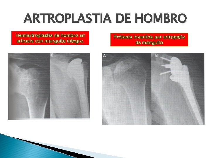 ARTROPLASTIA DE HOMBRO Hemiartroplastia de hombro en artrosis con manguito íntegro. Prótesis invertida por