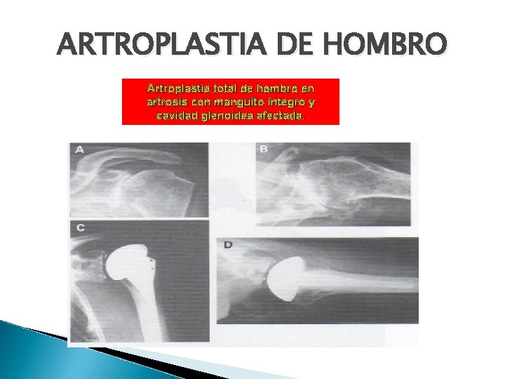 ARTROPLASTIA DE HOMBRO Artroplastia total de hombro en artrosis con manguito íntegro y cavidad