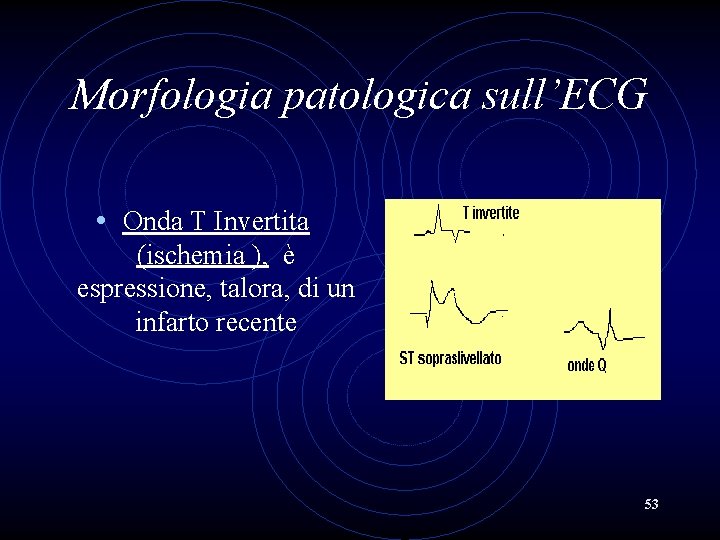 Morfologia patologica sull’ECG • Onda T Invertita (ischemia ), è espressione, talora, di un