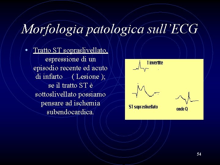 Morfologia patologica sull’ECG • Tratto ST sopraslivellato, espressione di un episodio recente ed acuto