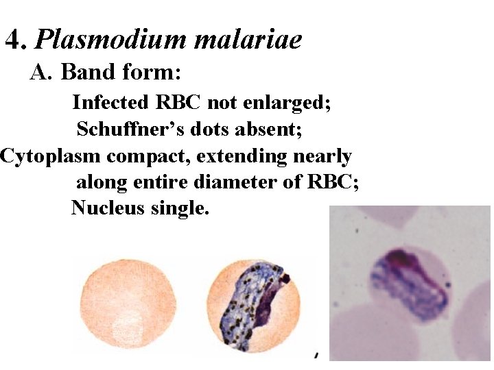 4. Plasmodium malariae A. Band form: Infected RBC not enlarged; Schuffner’s dots absent; Cytoplasm