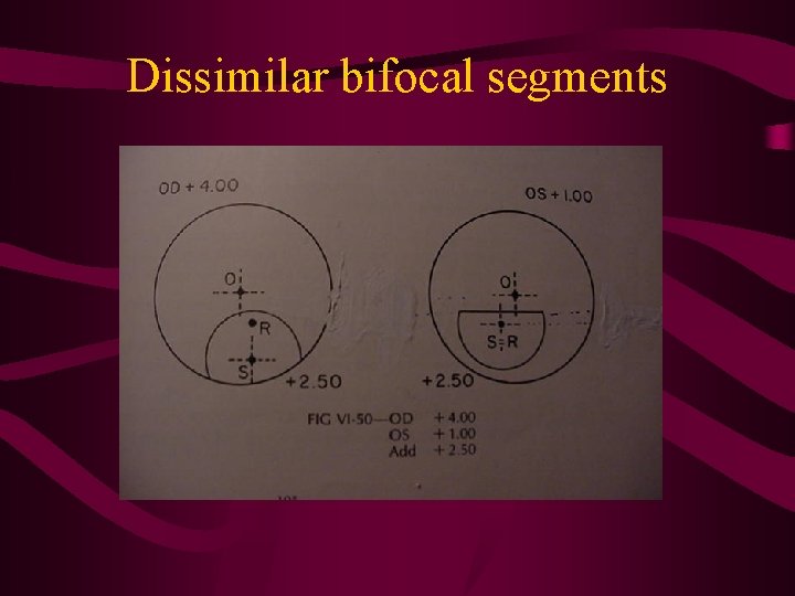 Dissimilar bifocal segments 