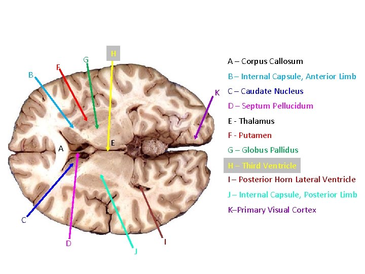 B G F H A – Corpus Callosum B – Internal Capsule, Anterior Limb