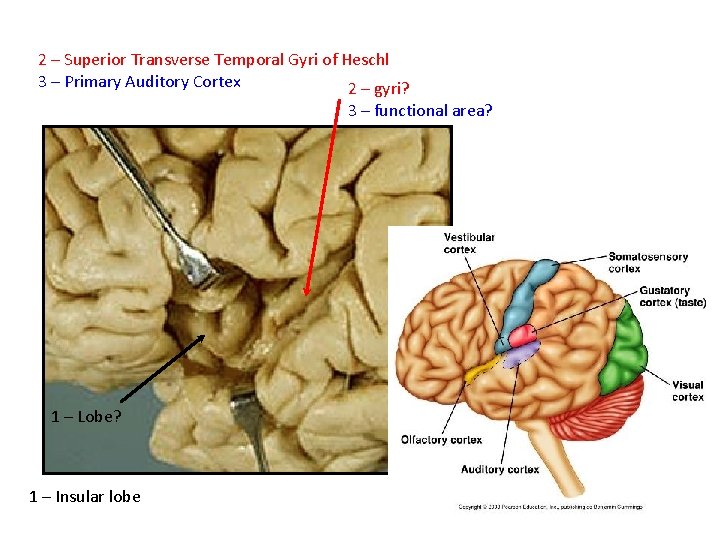 2 – Superior Transverse Temporal Gyri of Heschl 3 – Primary Auditory Cortex 2