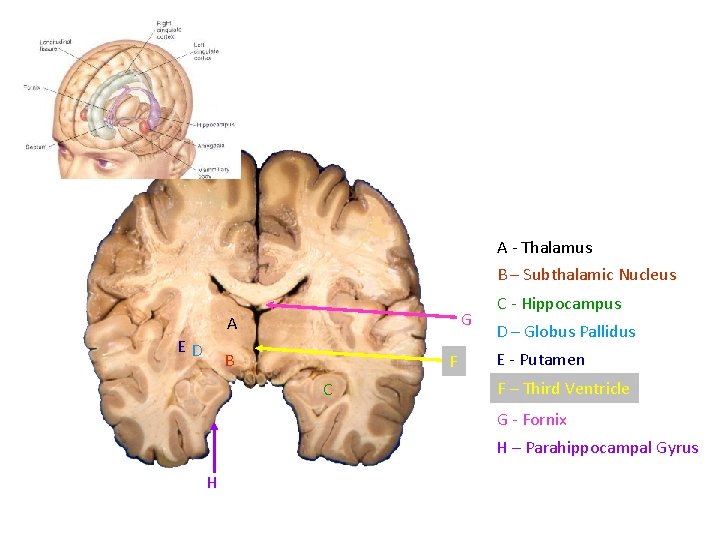 A - Thalamus B – Subthalamic Nucleus G A ED B F C C