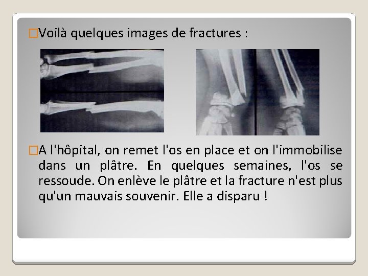�Voilà quelques images de fractures : �A l'hôpital, on remet l'os en place et