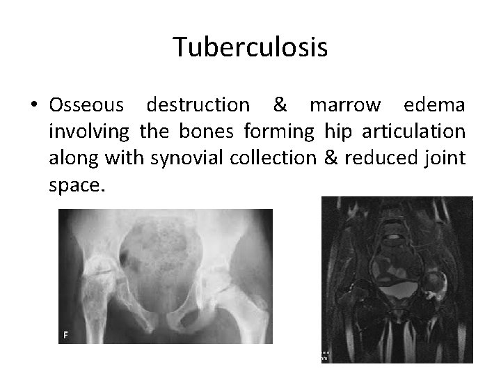 Tuberculosis • Osseous destruction & marrow edema involving the bones forming hip articulation along