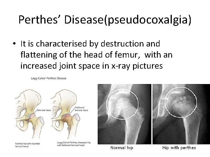 Perthes’ Disease(pseudocoxalgia) • It is characterised by destruction and flattening of the head of