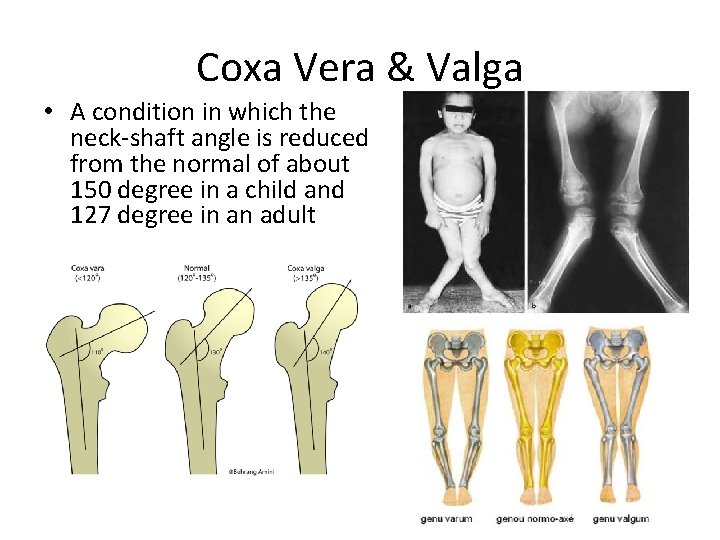 Coxa Vera & Valga • A condition in which the neck-shaft angle is reduced