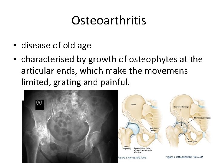 Osteoarthritis • disease of old age • characterised by growth of osteophytes at the
