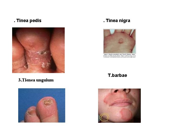 . Tinea pedis 3. Tienea unguium . Tinea nigra T. barbae 