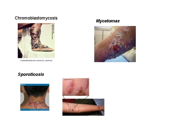 Chromoblastomycosis Sporoticosis Mycetomas 