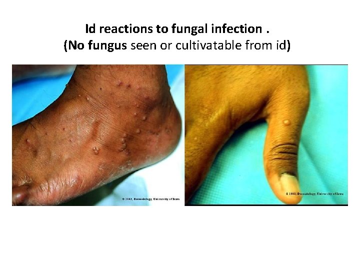 Id reactions to fungal infection. (No fungus seen or cultivatable from id) 