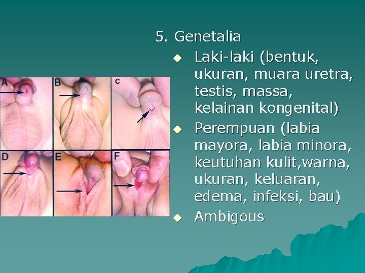 5. Genetalia u Laki-laki (bentuk, ukuran, muara uretra, testis, massa, kelainan kongenital) u Perempuan