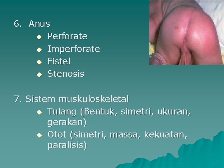 6. Anus u Perforate u Imperforate u Fistel u Stenosis 7. Sistem muskuloskeletal u
