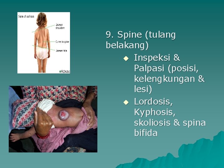 9. Spine (tulang belakang) u Inspeksi & Palpasi (posisi, kelengkungan & lesi) u Lordosis,