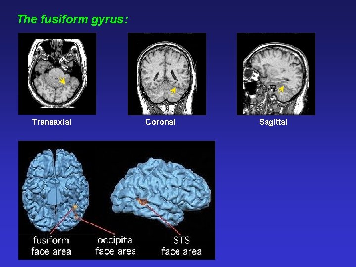 The fusiform gyrus: Transaxial Coronal Sagittal 