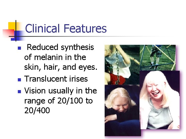 Clinical Features n n n Reduced synthesis of melanin in the skin, hair, and