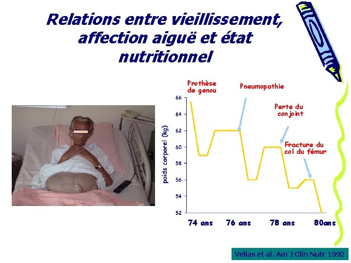 Relations entre vieillissement, affection aiguë et état nutritionnel Prothèse de genou Pneumopathie Perte du