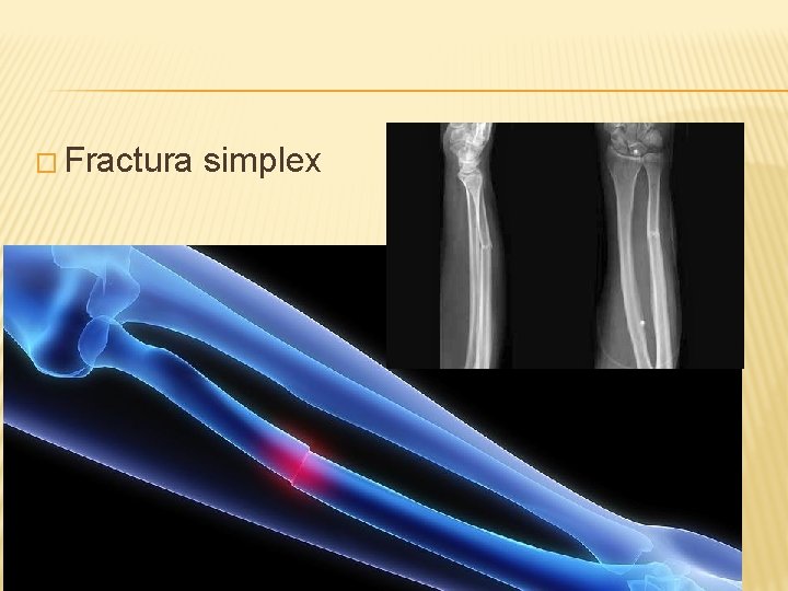 � Fractura simplex 
