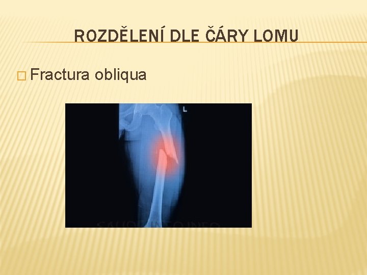 ROZDĚLENÍ DLE ČÁRY LOMU � Fractura obliqua 