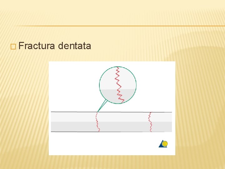 � Fractura dentata 