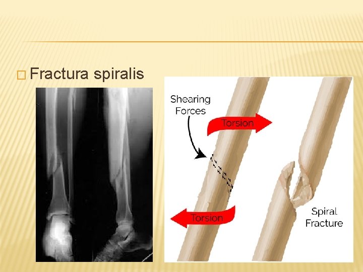 � Fractura spiralis 
