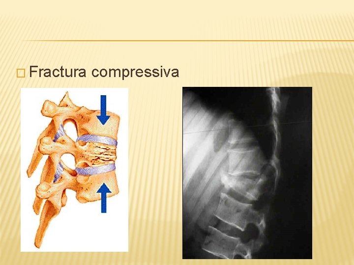 � Fractura compressiva 