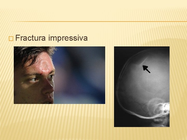 � Fractura impressiva 