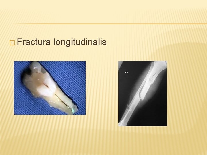 � Fractura longitudinalis 