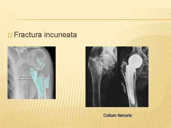 � Fractura incuneata Collum femoris 